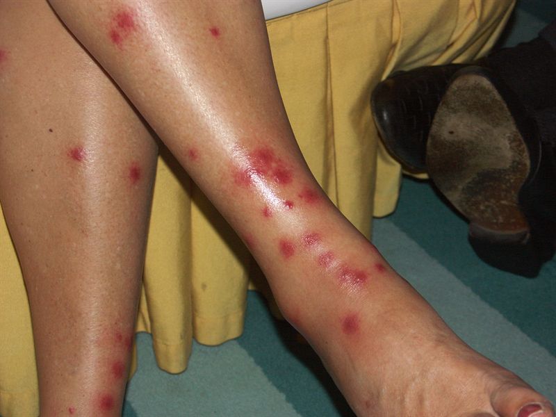 Gunilla blev biten av insekter sista kv�llen i Thailand med kraftiga utslag och feber som f�ljd