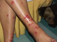Gunilla blev biten av insekter sista kv�llen i Thailand med kraftiga utslag och feber som f�ljd